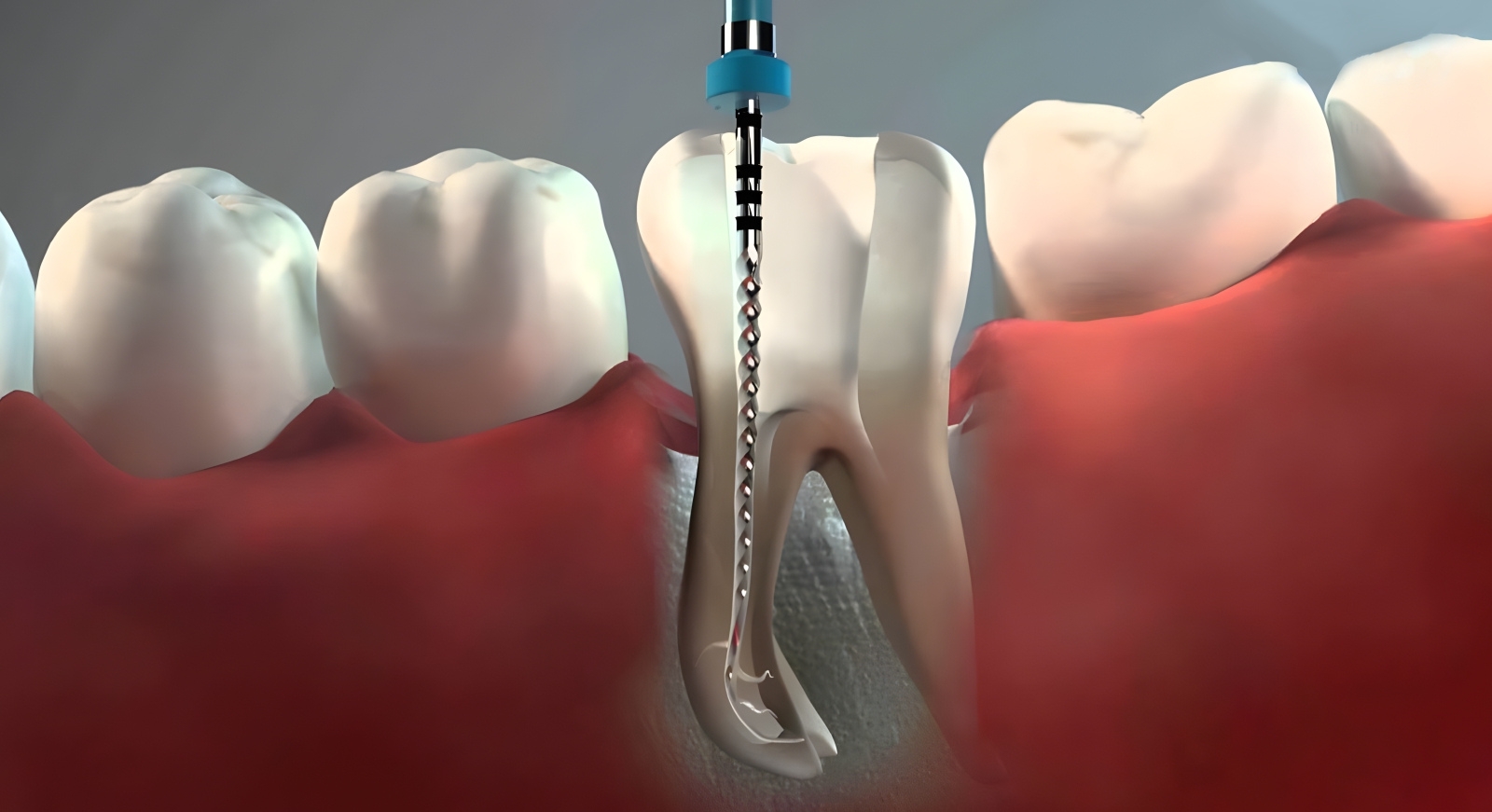 Root Canal Treatment for Kids in Chembur